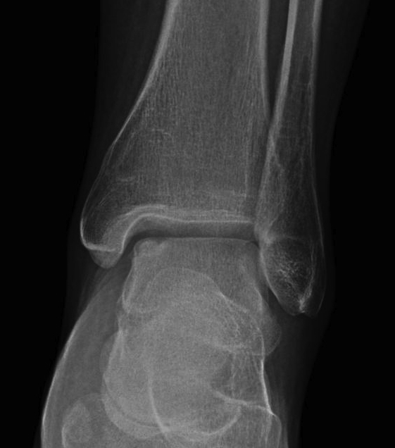 Talus OCD Medial